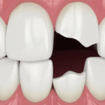 paciente revisando un diente roto en clínica dental