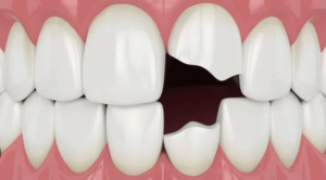 paciente revisando un diente roto en clínica dental